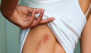 treatment of bed bug bites