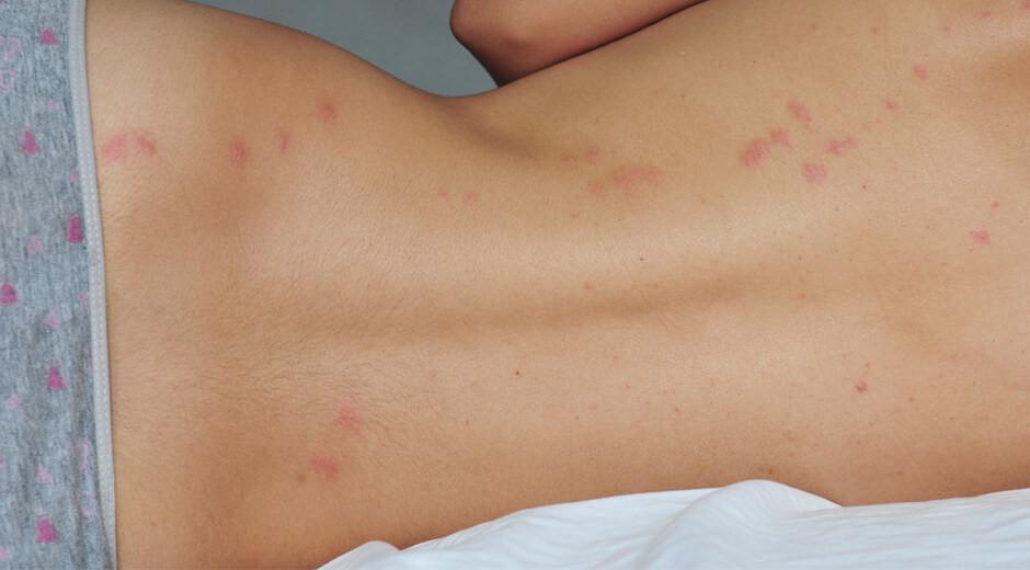 Bed Bug Bites